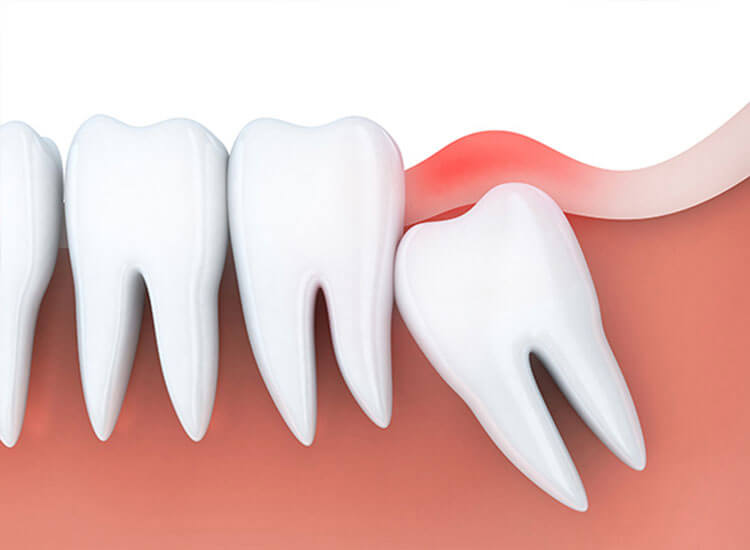 口腔外科・親知らず